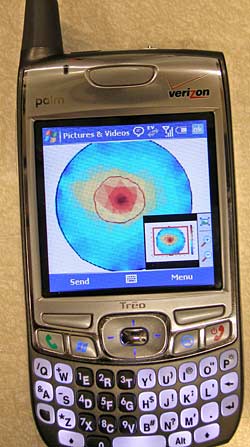 image of a simulated breast tumor on a cellphone