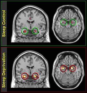 MRI image of hyperactive amygdala after sleep deprivation